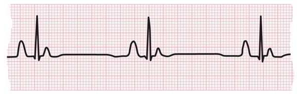 ECG strip showing bradycardia