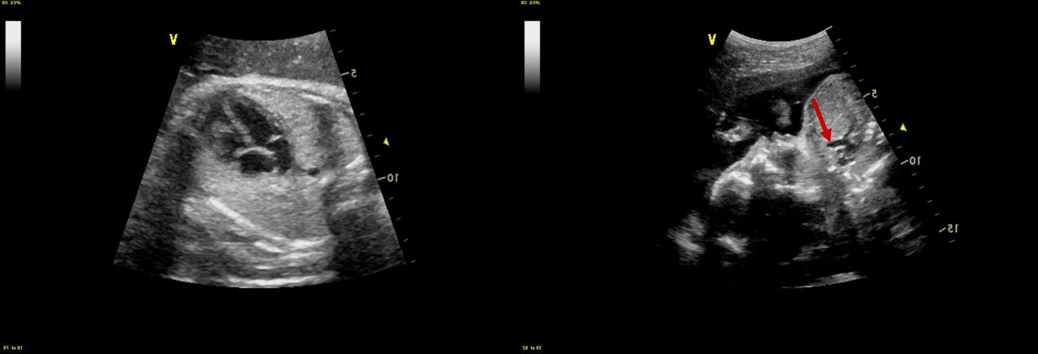 pe-img-fetalecho-internal