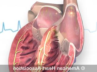 atrial fibrillation